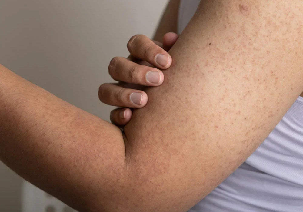 What is Keratosis Pilaris and how to improve it