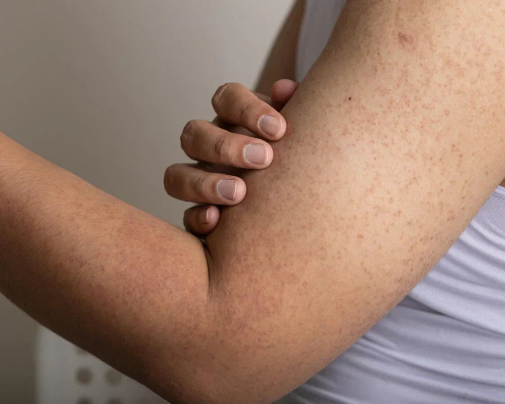 What is Keratosis Pilaris and how to improve it
